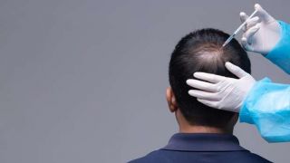 Queda de cabelo: saiba quais são as causas e como tratar