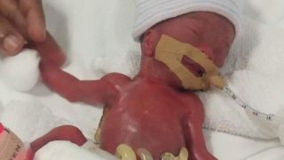 Nascida com apenas 212 gramas, a menor bebê do mundo recebe alta de hospital em Singapura