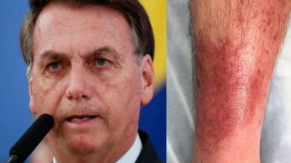 Erisipela: entenda a doença que mantém Bolsonaro longe de aparições públicas