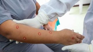 Organização Mundial da Saúde decide renomear varíola dos macacos como mpox
